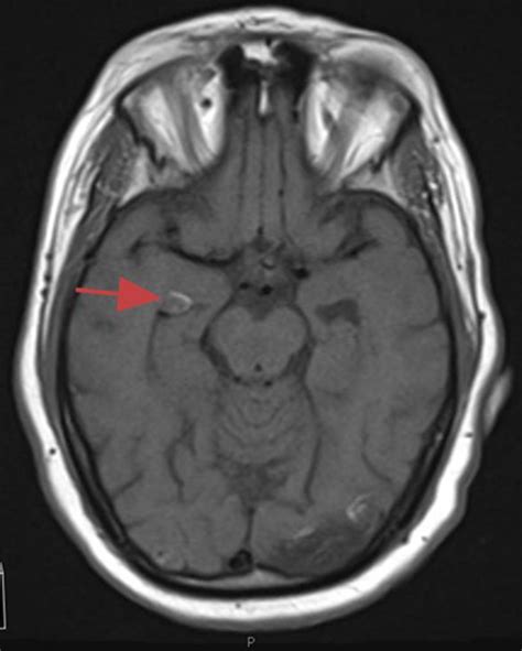 the villages mri with contrast|MRI with and without Contrast in the The Villages Region.